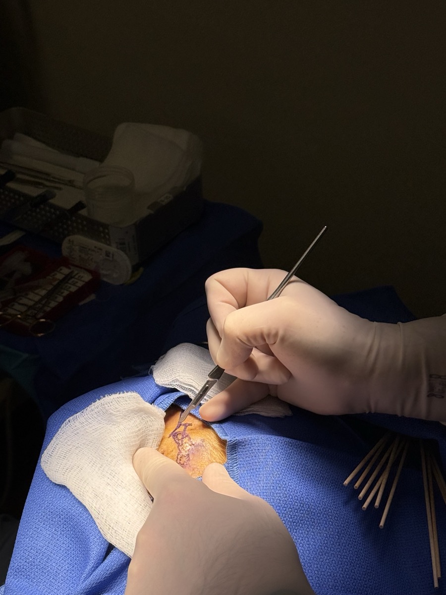 Mohs micrographic surgery performed by Dr. Hardy
